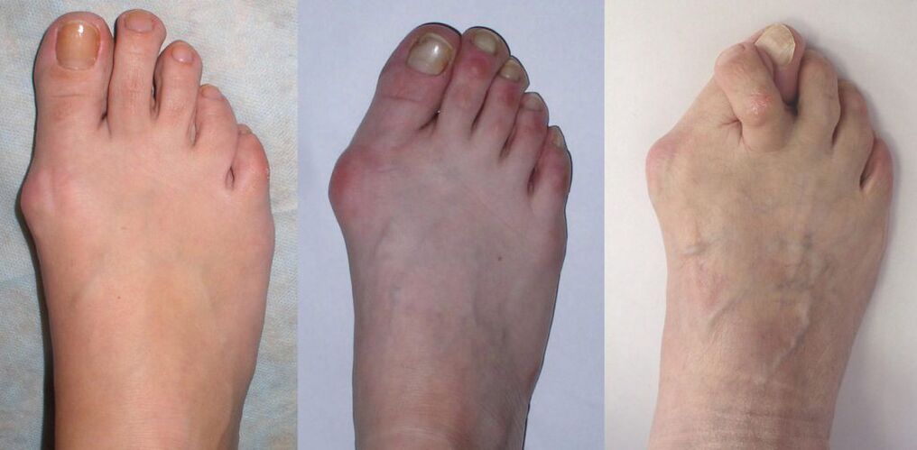 Arthrite du pied