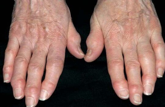 Arthrose des mains