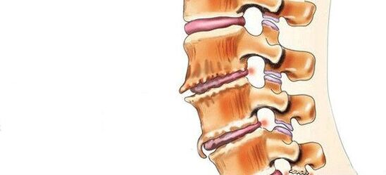 Qu'est-ce que le spondylose