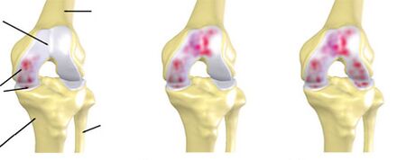 Degré d'arthrose