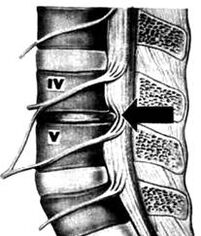 Image x-ray du département lombaire de l'ostéochondrose
