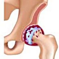 Arthrose de l'articulation de la hanche