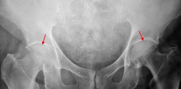 Image coksartrose à double face de l'écart commun, sclérose des surfaces articulaires