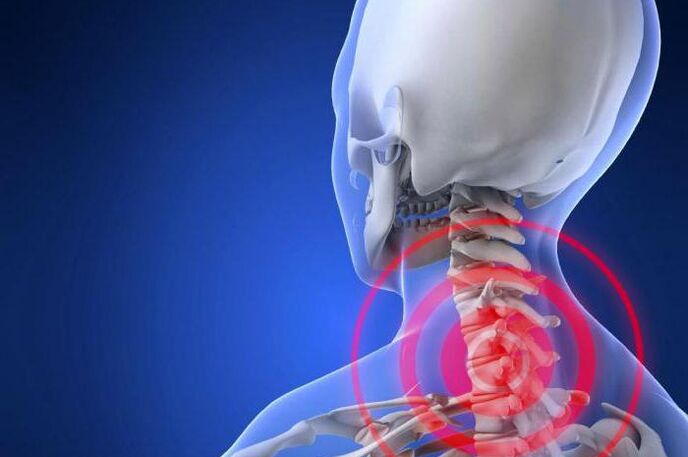 La douleur lancinante dans le cou est un symptôme précoce de l'ostéochondrose cervicale