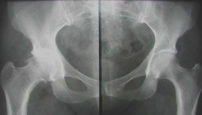 Radiographie de l'articulation de la hanche affectée avec arthrose